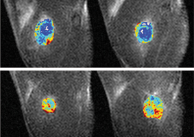 High levels of Ferritin show up in red, low levels in blue